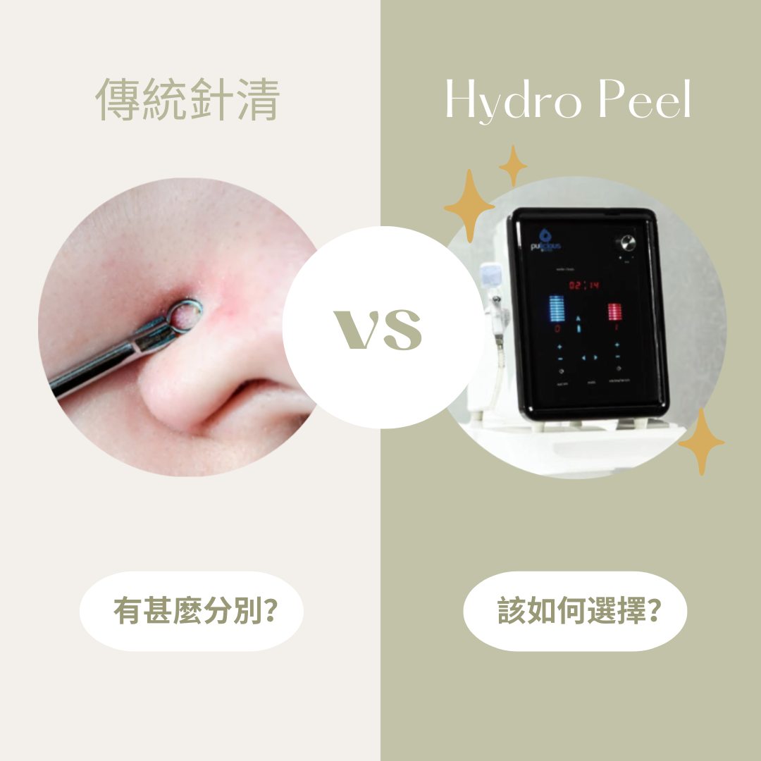 【護膚知識】Baby Hydro Peel 療程 VS 傳統針清｜黑頭粉刺、毛孔粗大應該點揀？
